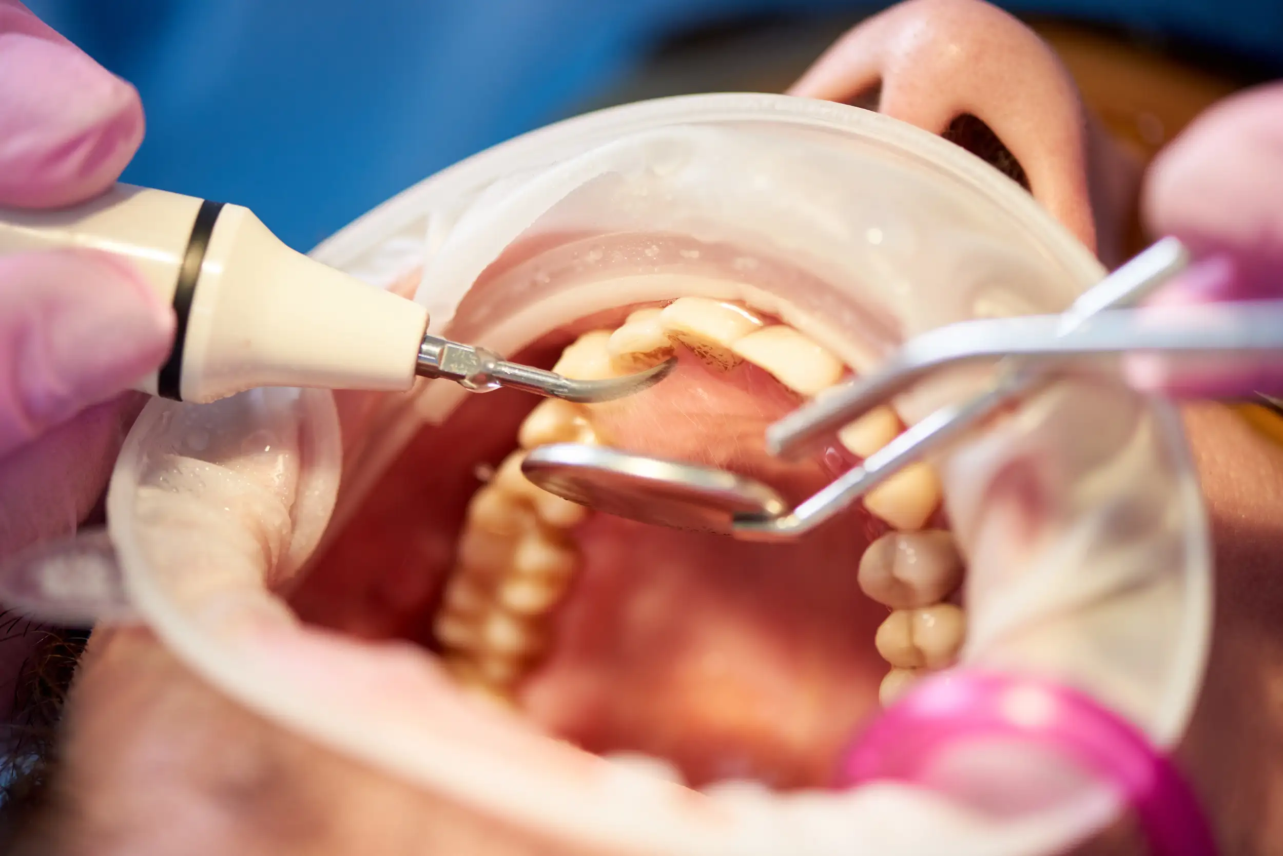 A zoomed image of a patient that examines his tooth.