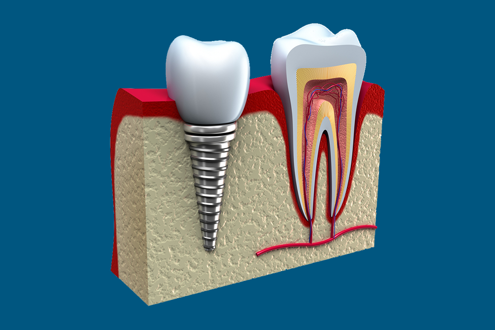 A presentation of how surgery is made to the root canal